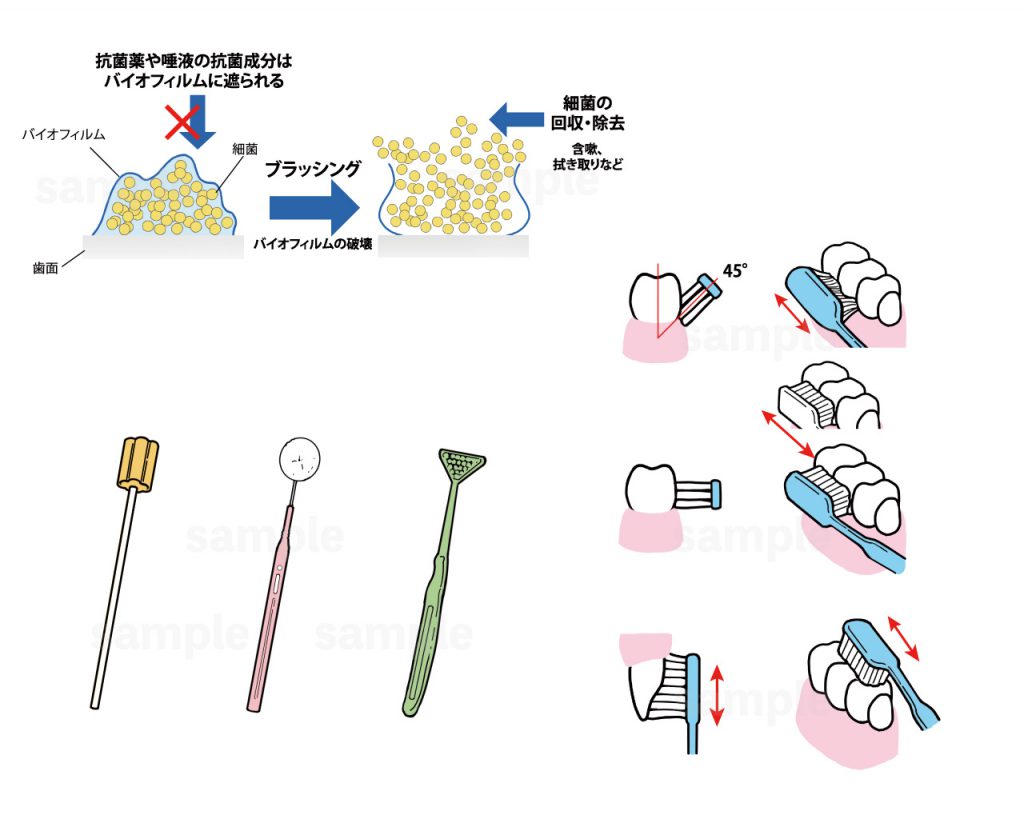 Asterisk Discovery ナース専科 口腔ケアに関する記事の挿絵