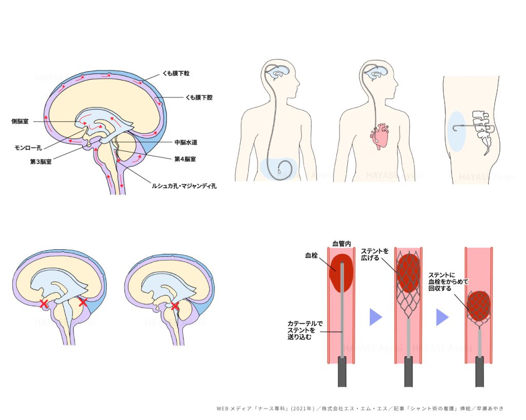 看護 医療 解剖生理 脳 血管 水頭症