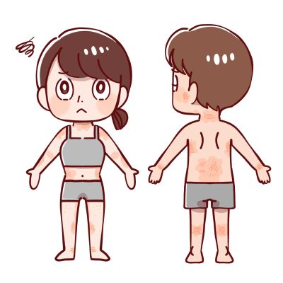 アトピー性皮膚炎、炎症部分、イラスト